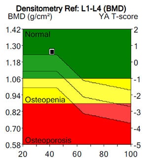 Easy to understand DEXA Osteoporosis Scan Result